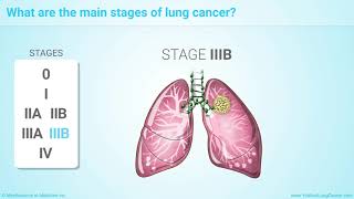 Staging of Lung Cancer [upl. by Abel836]