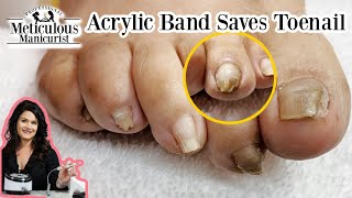 How to Fix a Pincer Toenail with Acrylic Journey [upl. by Einner665]