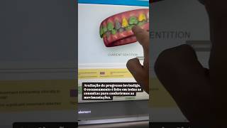 Avaliação de progresso Invisalign com scanner iTero invisalignbrasil odontologia [upl. by Lotte54]