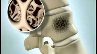 Vertebral Compression Fracture  DePuy Videos [upl. by Ailasor595]