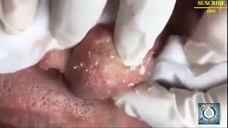 Extreme Nose Blackhead Removal [upl. by Macnamara349]