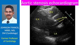 Aortic stenosis  echocardiogram [upl. by Christenson]