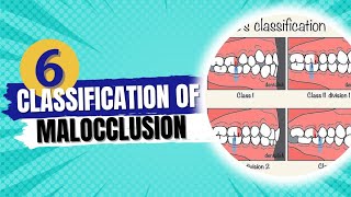 Classification of malocclusion  Orthodontics course [upl. by Macdermot]