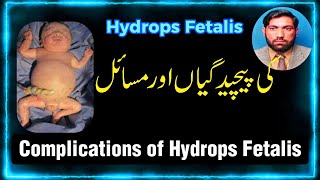 Complications of Hydrops Fetalis کی پیچید گیاں اور نقصانات Hydrops Fetalis [upl. by Burdelle]