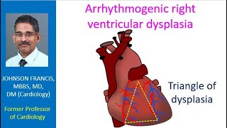 Arrhythmogenic right ventricular dysplasia [upl. by Sykes891]