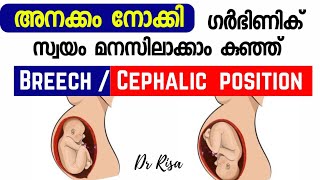 Cephalic vs Breech Baby Movement  Baby Head Down Symptoms Pregnancy Baby Movement [upl. by Shaner]