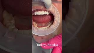 Zirconium Crowns Transformation at Dentatur in Turkey dentatur dentalcrownsturkey [upl. by Netsrijk]