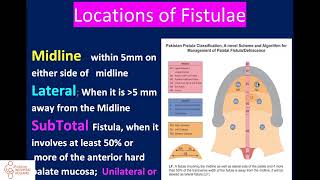 Webinar Interplast quotCleft palate fistula treatmentquot by profdr Fayyaz on May 22nd 2024 [upl. by Mamie]