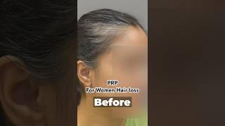 Female PRP Results  Treatment For Women Hair Loss Before amp After [upl. by Placidia]