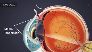 Tratamentos para o Glaucoma TRABECULECTOMIA [upl. by Aimit766]