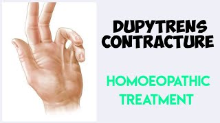 Dupuytrens contracture homeopathic treatment डुपायट्रेन्स कॉन्ट्रेक्चर का होम्योपैथिक ईलाज [upl. by Amary289]