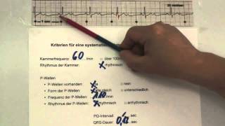 EKG für Pflege Teil 25  AVBlock 3 Grades interpretieren [upl. by Ailee]