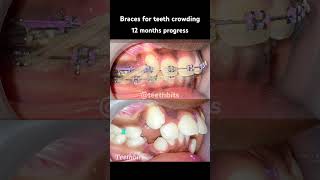 Crooked teeth Braces in 12 months progress braces orthodontics dental dentist teethbits [upl. by Nainatrad]