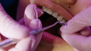 Gingivitis Treatment How Much Will it Cost Discover Affordable Options Now [upl. by Idmann]