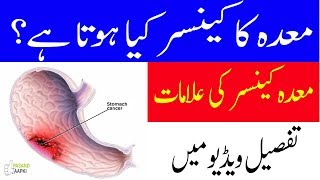 stomach cancer symptoms  stomach ulcer  ulcer information in urdu with Dr KhurramPasand Aapki [upl. by Vine868]