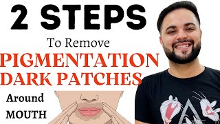 2 STEPS to Remove Pigmentation amp Dark Patches around Mouth [upl. by Ailadgim]