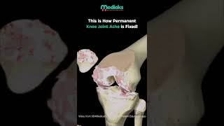 Understanding Knee Replacement Surgery StepbyStep Guide amp Recovery Tips  Medioks [upl. by Dorita]