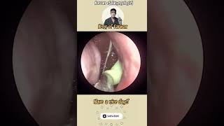 귀지형 콧물 부비동염 축농증 비염 코청소 이비인후과 rhinorrhea rhinitis sinusitis ASMR [upl. by Annairda630]