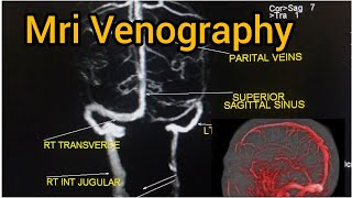 Mri Venography Brain Fillming Easy Technique in Hindi mriVenogram Mrivenography venographybrain [upl. by Markman]