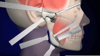 Custom Patient Specific TMJ Replacement [upl. by Linker]