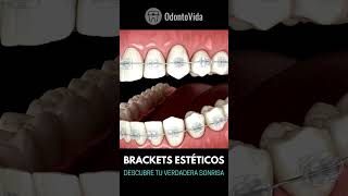 BRACKETS ESTÉTICOS [upl. by Reinar]