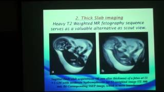 Role of fetal MRI in assessment of ventriculomegaly [upl. by Athiste930]