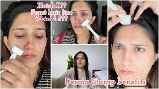 Derma stamp benefits for hair fall amp aging  Hairfall guide by Natasha waqas [upl. by Elliot214]