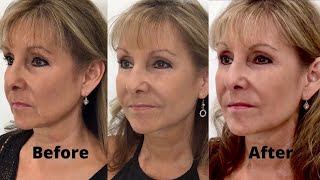 How to Get Rid of Jowls with Dermal Fillers Step 3 [upl. by Scarlett736]