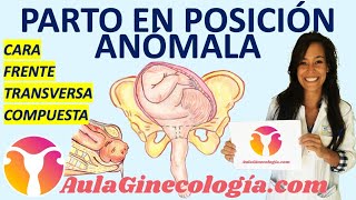 💥 PARTO EN POSICIONES ANÓMALAS💥 CARA FRENTE TRANSVERSA COMPUESTA  Ginecología y Obstetricia [upl. by Nilekcaj451]