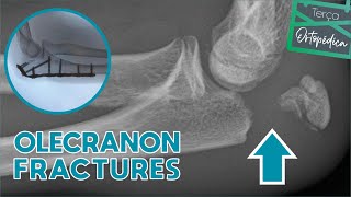 OLECRANON FRACTURES Dr Eric Curi  Ortopedista Ombro e Cotovelo [upl. by Aliekat457]