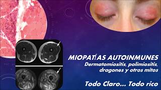 Miopatías autoinmunes  dermatomiositis polimiositis y dragones todo claro todo rico [upl. by Ttreve359]