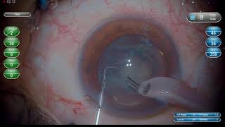 Dr Sourabh Patwardhan Live Cataract surgery For training and consultation call 7028402375 [upl. by Tom510]