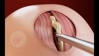 Percutaneous minilaparotomy fetoscopic treatment of Open Spina Bifida [upl. by Jonah319]