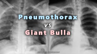 Pneumothorax vs Giant Bulla in Chest X Ray Part 6 [upl. by Hesketh424]