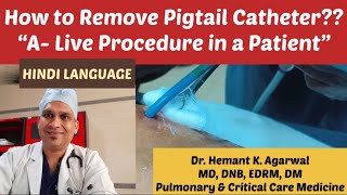 How to Remove Pigtail Catheter “A Live Procedure in a Patient” HINDI Dr Hemant Kumar Agarwal [upl. by Barraza]