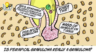 What is periapical granuloma [upl. by Aenil]