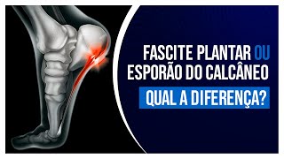 QUAL A DIFERENÇA ENTRE FASCITE PLANTAR E ESPORÃO DO CALCANEO [upl. by Pahl609]