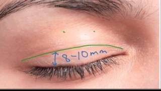 Marking the Upper Eyelid Incision [upl. by Marshal]