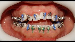 Orthodontic Treatment of Anterior Open Bite  Mahmoud 22yrs [upl. by Adnanref771]