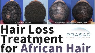 Hair Loss in African Hair  Causes Treatments and Ethnic Considerations [upl. by Eblehs]