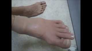 Ön Ayak Protezi  Forefoot Prosthesis  Chopart Pirogoff Lisfranc [upl. by Nwatna]