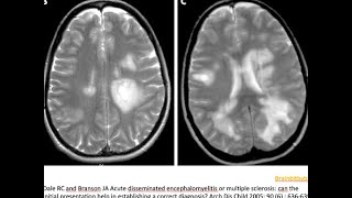 41 ADEM acute disseminated encephalomyelitis demyelination paediatric MOG AB post infectious [upl. by Perrine]