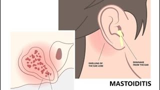 ।।Mastoiditis।। MSN  2nd June 2024 me aaya hua question ।। GNM 2nd year ।। [upl. by Nrubliw]