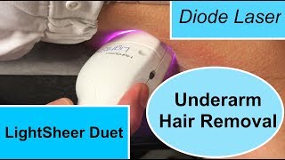 The LightSheer Duet Diode Laser for Underarm Hair Removal [upl. by Namaj]