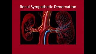 Renal Sympathetic Denervation [upl. by Vescuso666]