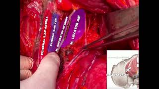 LUMBOSAKRAL PLEXUS VE PELVİK YAN DUVAR ANATOMİSİ LUMBOSACRALPLEXUS PELVICSIDEWALLANATOMY [upl. by Daune543]