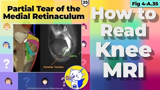 Fig 4A35 Partial Tear of the Medial Retinaculum [upl. by Areid]