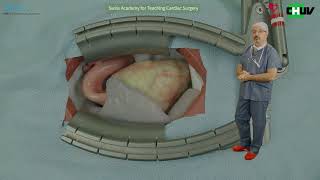 Demystifying Mitral Valve Regurgitation Repair Surgical Techniques for Residents in Cardiac Surgery [upl. by Sivra]