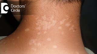 Pharmacological management of Tinea Versicolor in young individuals  Dr Urmila Nischal [upl. by Aryan40]