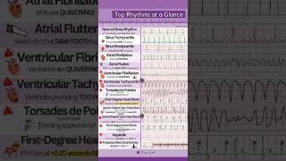 Sinus rhythm sinus tachycardia atrial fibrillation ventricular fibrillation heart block [upl. by Luhar]